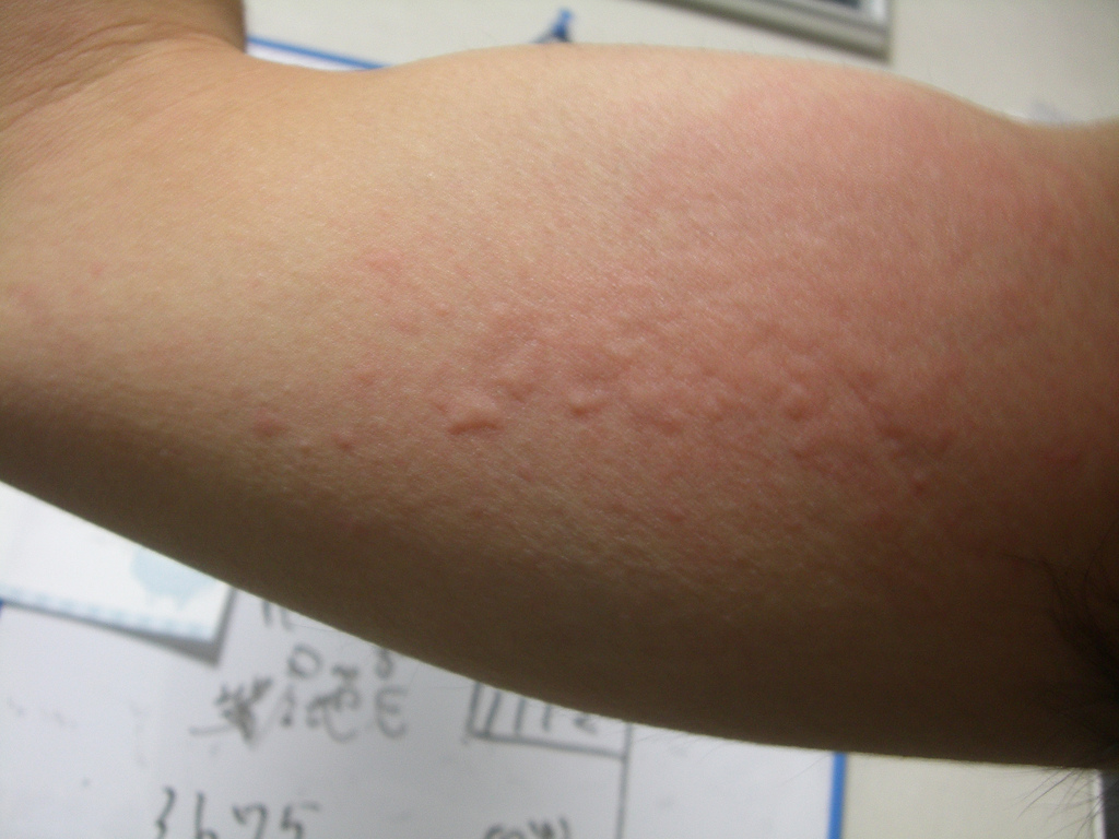 金属アレルギーの原因、治療法